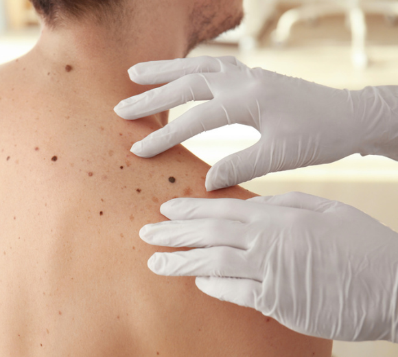 Person being examined by a dermatologist with gloves on their shoulder